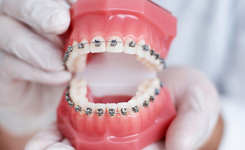 Braces